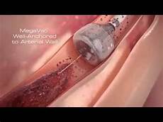 Medical Check Valve