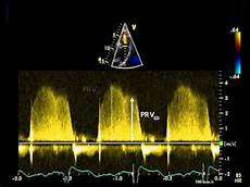 Pulse Valve
