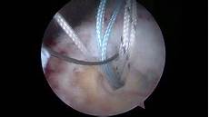 Suture Anchor