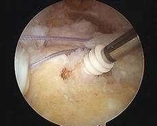 Suture Anchor