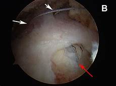 Suture Anchors