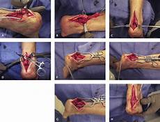 Suture Anchors