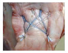 Suture Screw Anchor