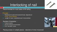 Tibial Nails