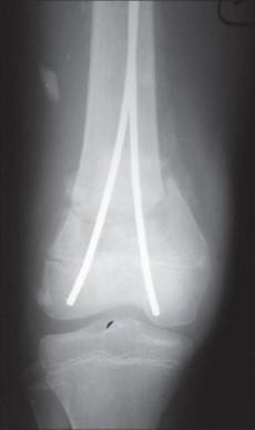 Tibial Nails