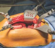 Vascular Bulldog Clamp